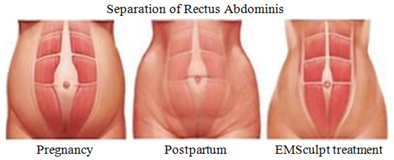 Improve separation of rectus abdominis.