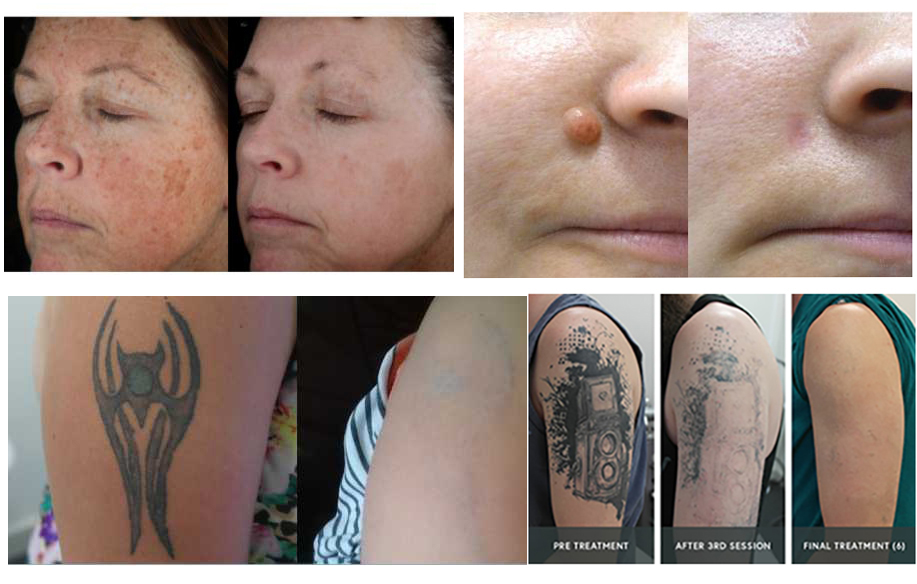 tattoo removal