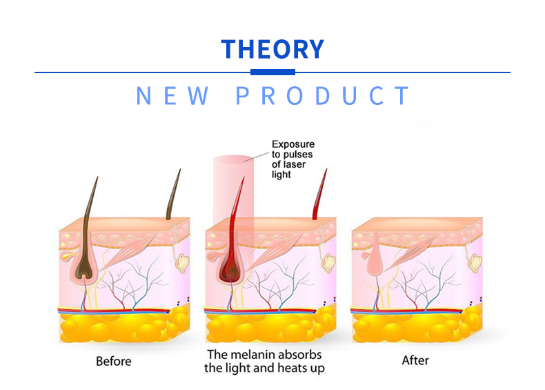 hair removal machine