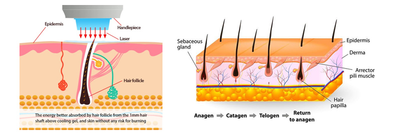 Laser Hair Removal Machine 