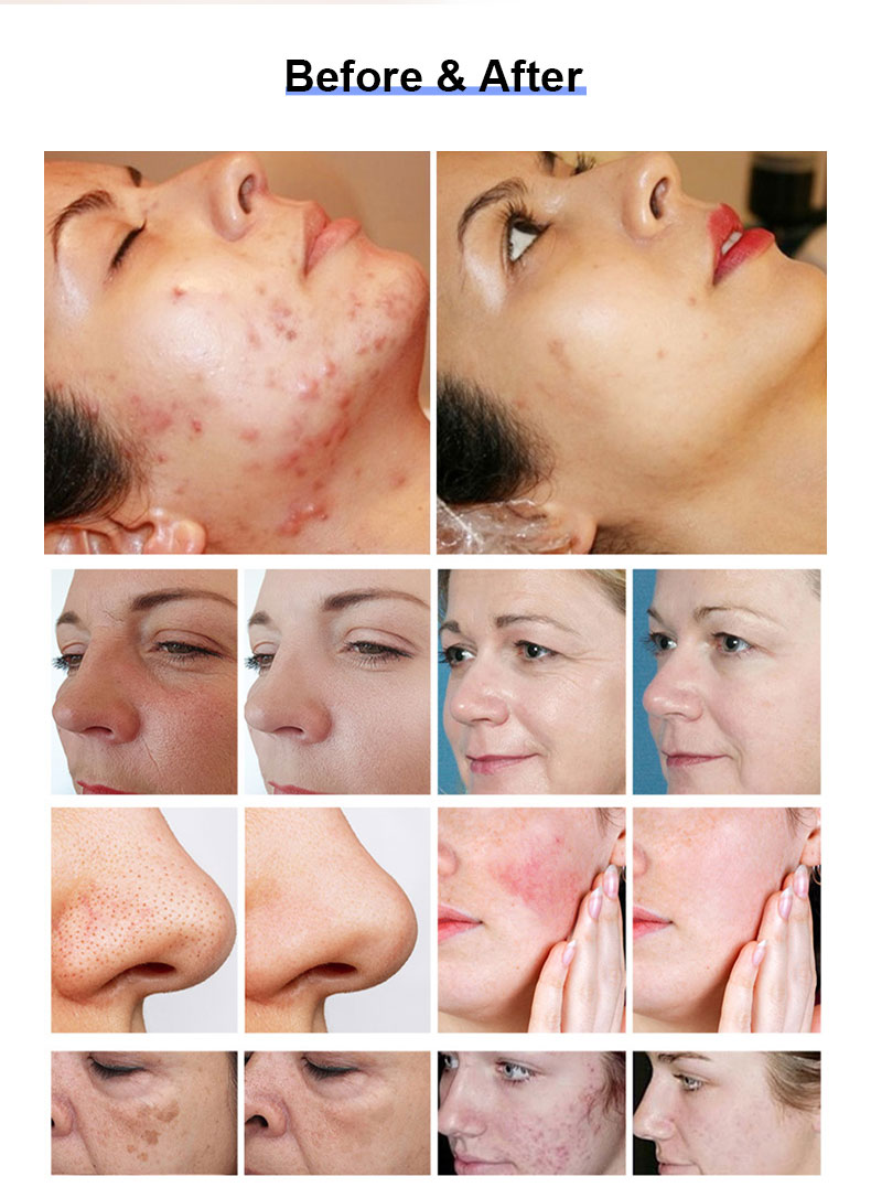 1927nm Thulium Fractional Laser