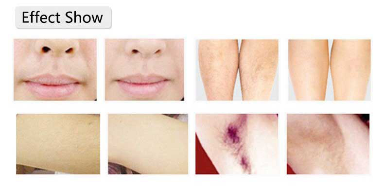 hair removal laser