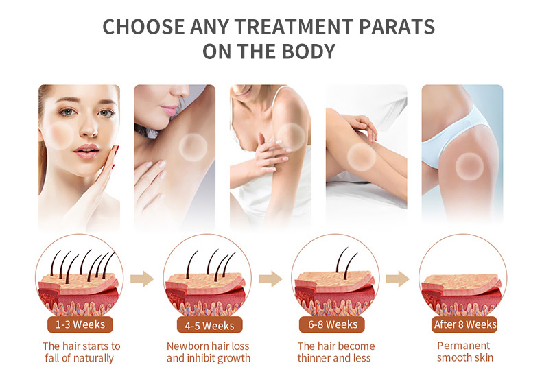 hair removal machine