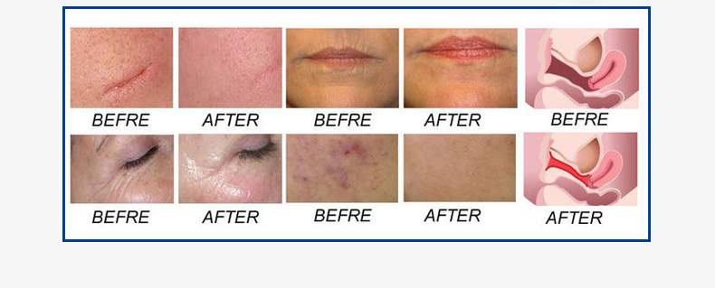 Professional CO2 Fractional Laser Machine