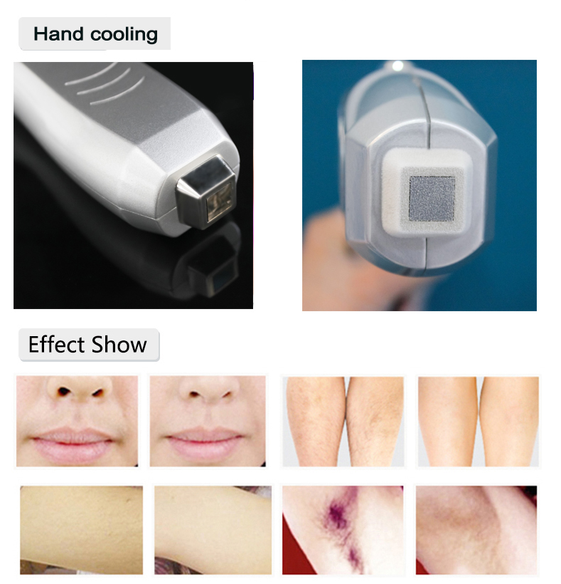 laser hair removal