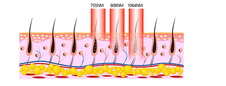 hair removal machine theory