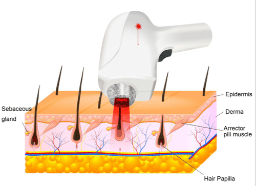 Which Is Better IPL Or Diode Laser Machine?