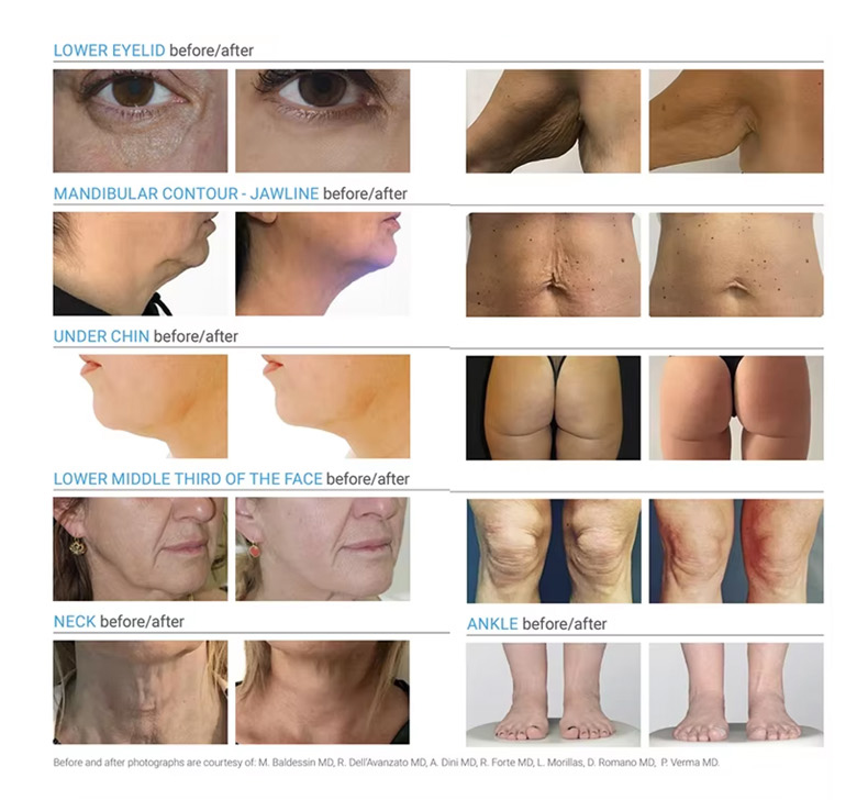 diode laser lipolysis machine