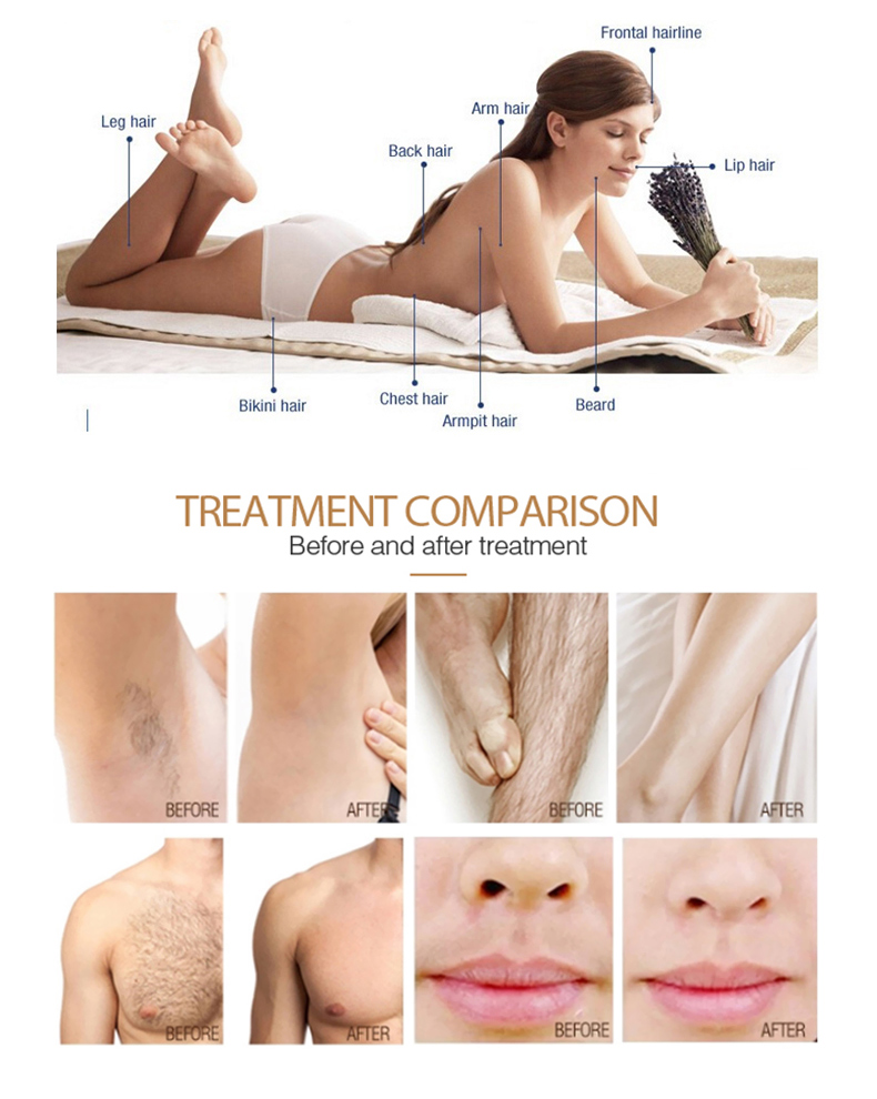 hair removal machine