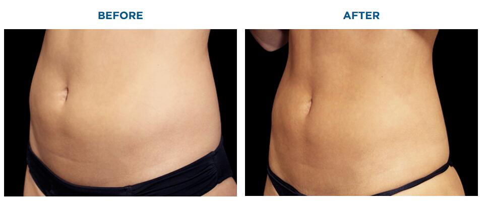 weight loss machine