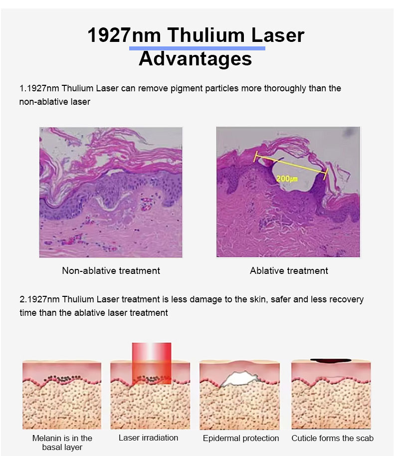 1927nm Thulium Fractional Laser