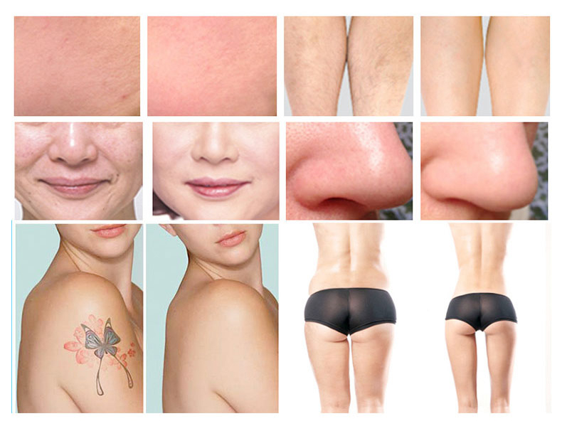 E-light + NdYAG Laser+lipolaser+RF