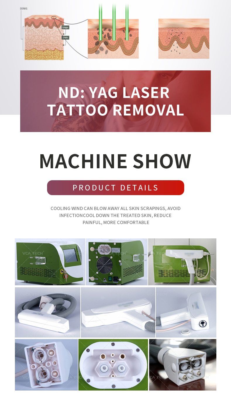 laser tattoo removal machine