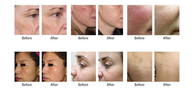 Skin Rejuvenation machine