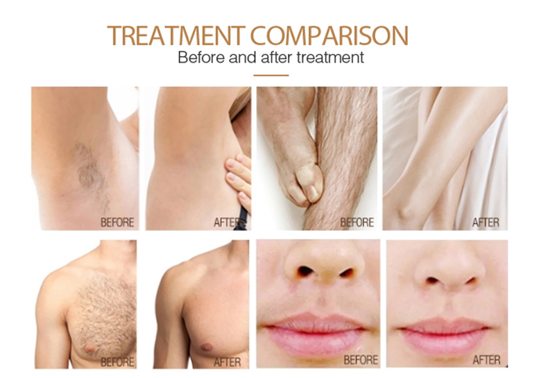 Laser Hair Removal Diode Machine