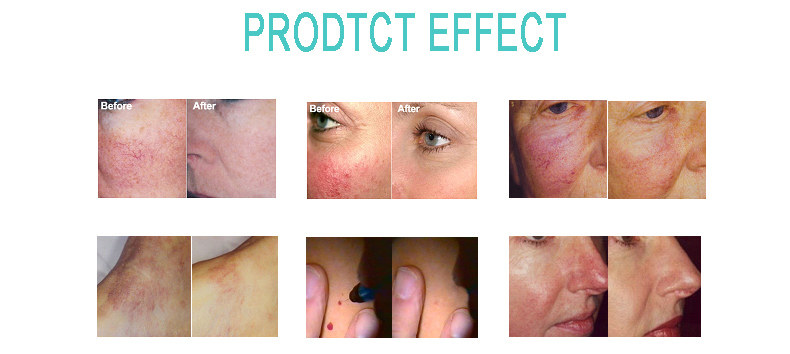 Spider Vein Removal Machine