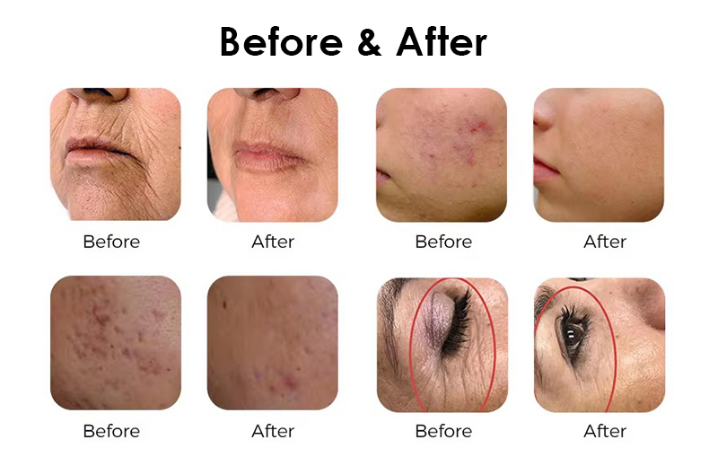 1550nm Erbium Glass&nbsp;Laser&nbsp;