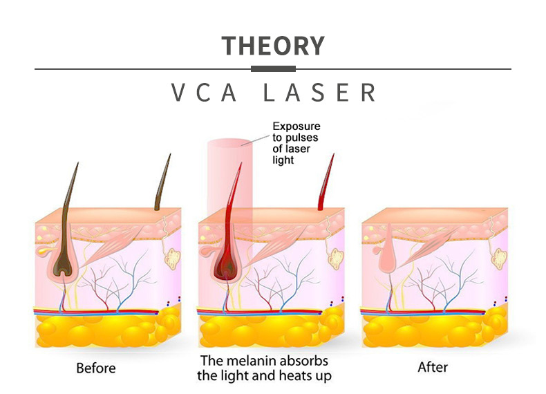 Medical Laser Hair Removal Machine