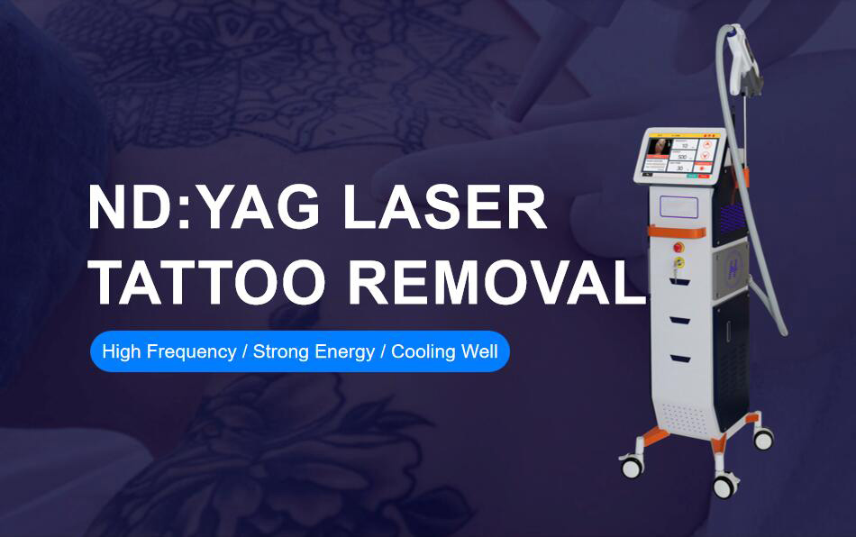 Best Laser Machine for Tattoo Removal