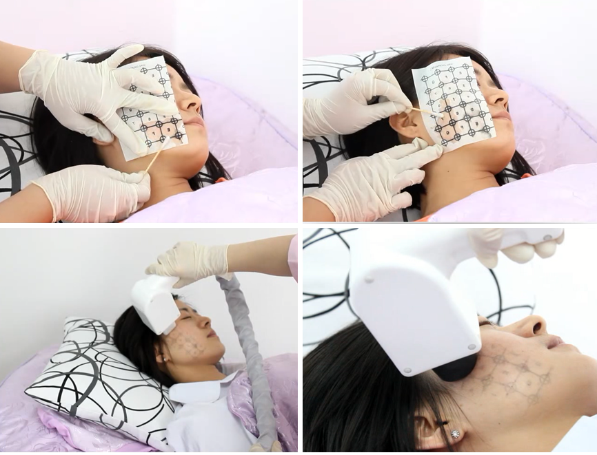 thermage clinical treatment