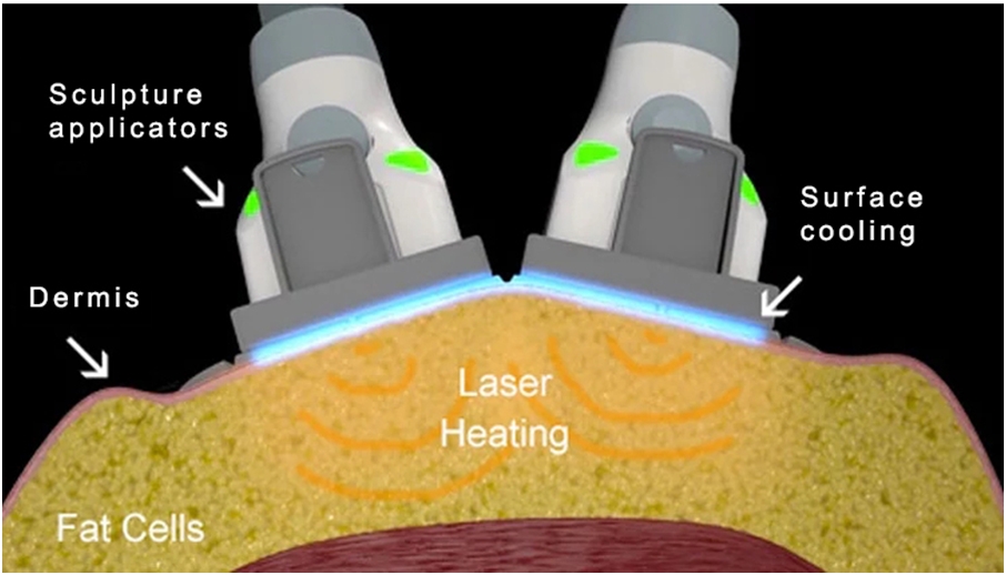 SculpSure 1060nm Diode Laser Body Contouring Beijing VCA Laser