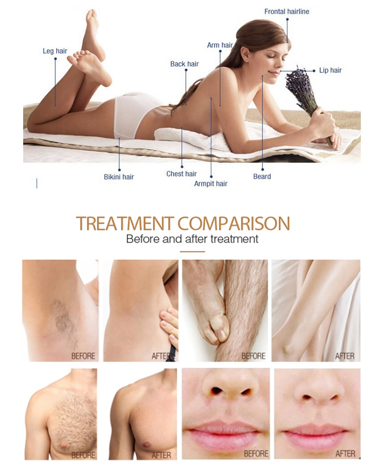 laser hair removal