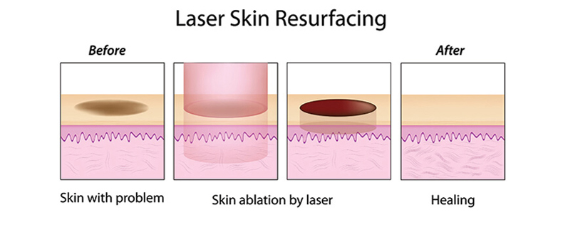 CO2 Fractional Laser Machine