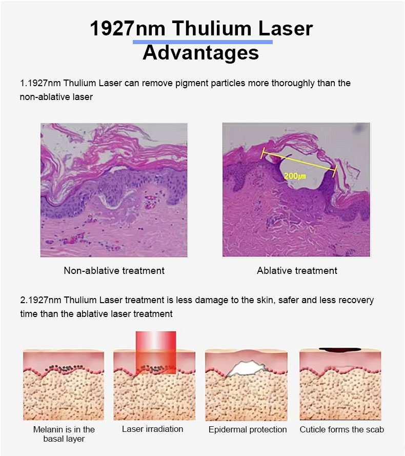 1927nm Thulium Fractional Laser