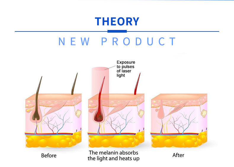 hair removal machine