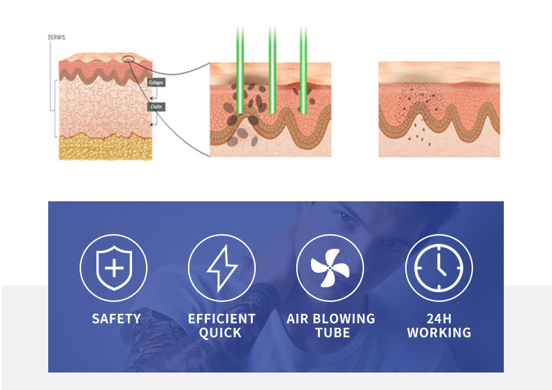 tattoo removal machine