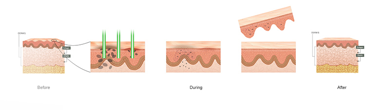 laser machine for tattoo removal