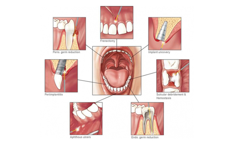 dental laser machine