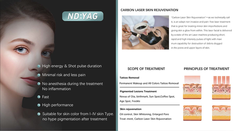 laser tattoo removal